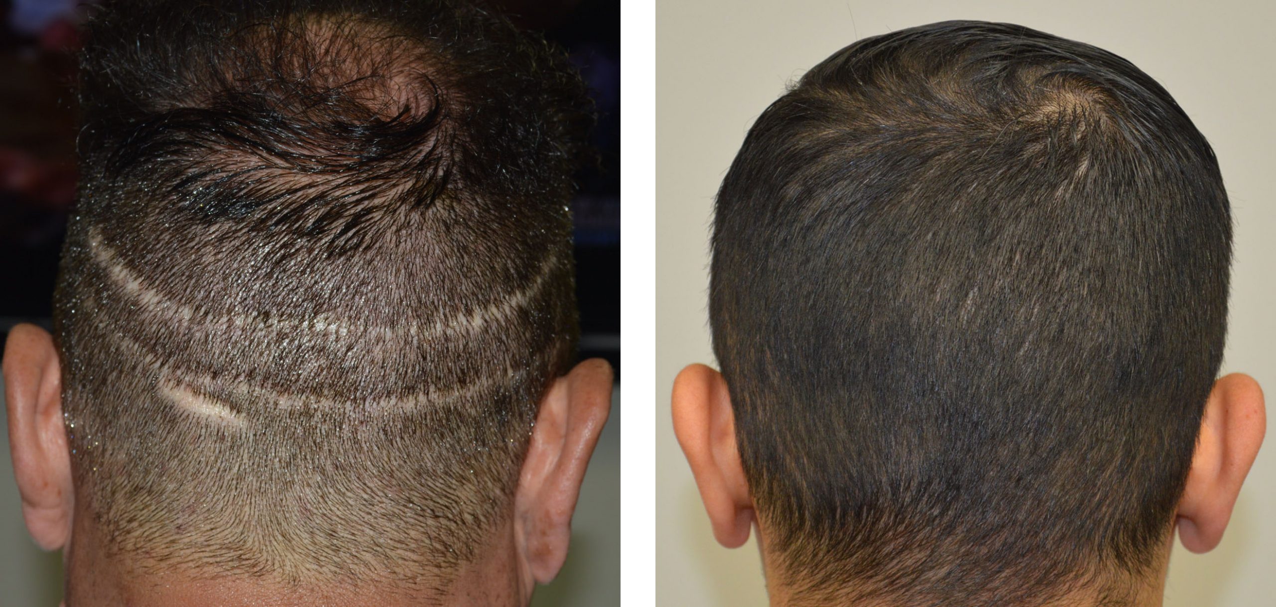 Dr U Hair Clinic Los Angeles Patient Results Hair Transplant Repair Results  Gallery