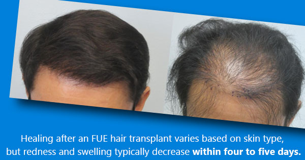 cost of hair transplant in los angeles