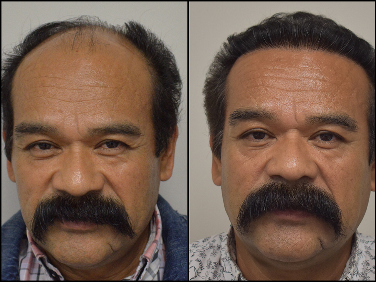 Before After La Fue Hair Clinic Los Angeles Fue Hair Transplant Clinic