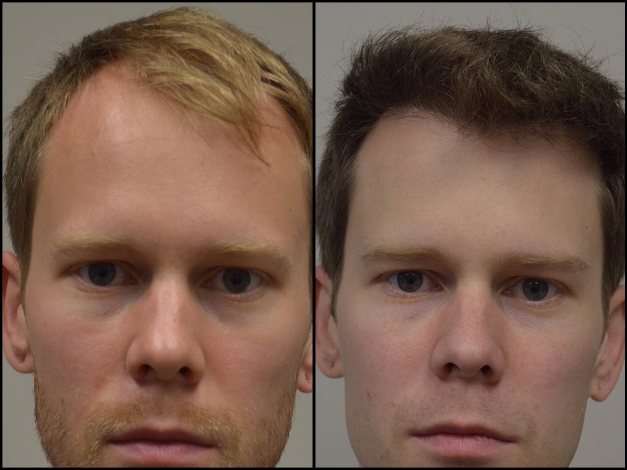 Before After La Fue Hair Clinic Los Angeles Fue Hair Transplant Clinic