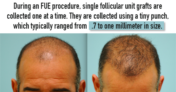 Do You Have a Scar on Your Scalp? Consider an FUE Transplant - LA FUE Hair  Clinic – Los Angeles FUE Hair Transplant Clinic