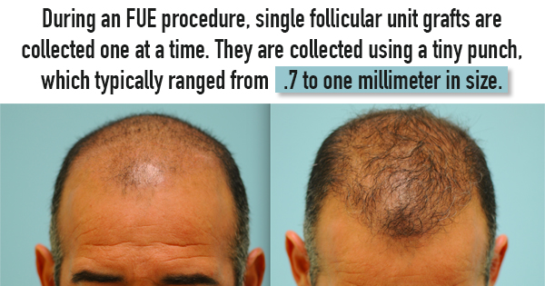 hair transplant scar