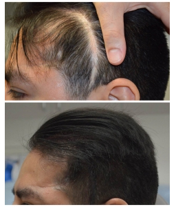 Scar Revision Los Angeles - LA FUE Hair Clinic – Los Angeles FUE Hair  Transplant Clinic