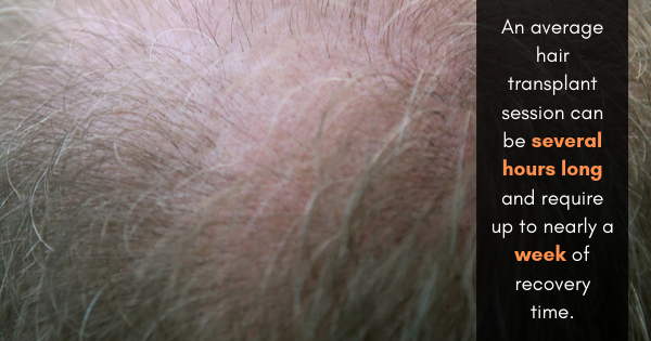 hair transplant surgery los angeles