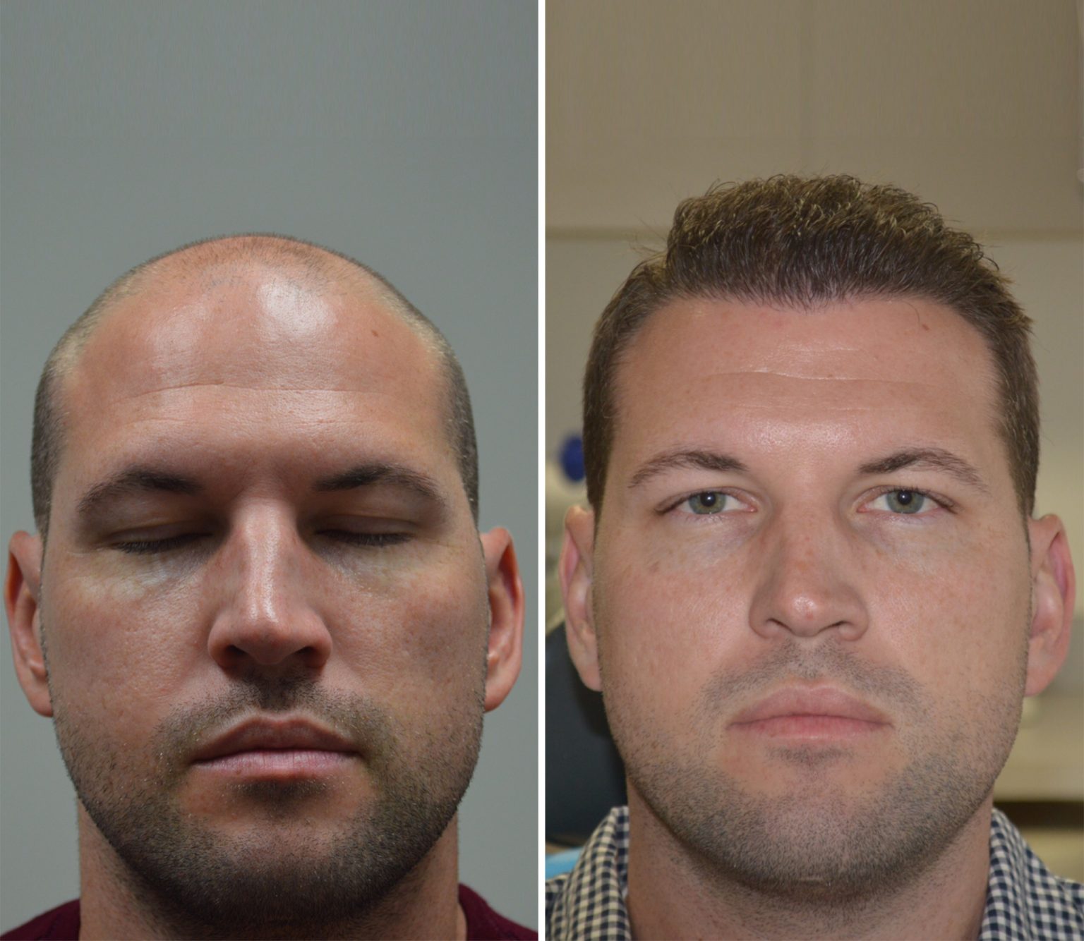 FUE Hair Transplant Los Angeles Los Angeles FUE Hair Replacement