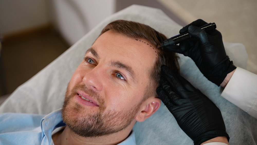fue hair transplant